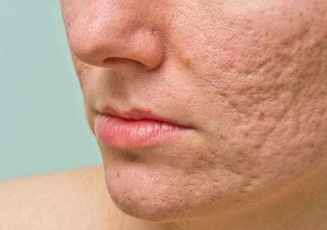 How to Get Rid Of Acne Scars
